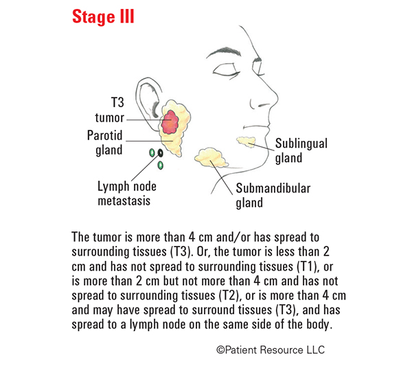 Head Neck Salivary Gland Cancer